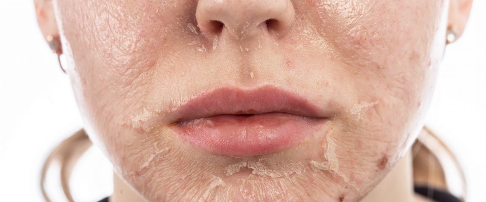 When to Use a Chemical Peel for Optimal Results