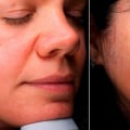 Unveil Your Most Beautiful Skin with Chemical Peels