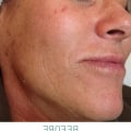 Do Chemical Peels Get Rid of Beauty Marks?