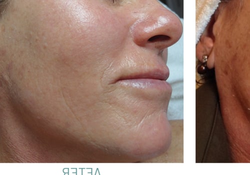 What Does a Chemical Peel Do and How Can It Benefit Your Skin?