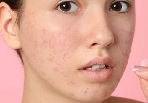 What Chemical Peel is Best for Rosacea?