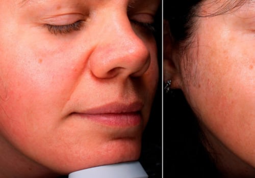 Unveil Your Most Beautiful Skin with Chemical Peels