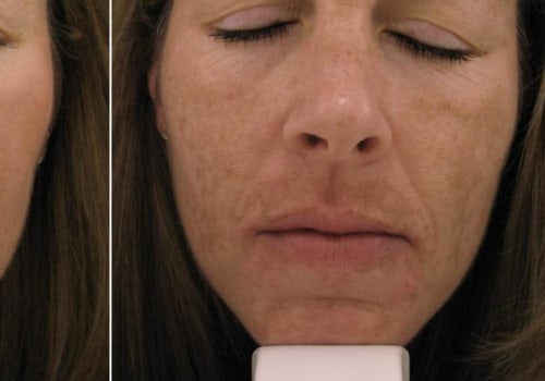 Do Dark Spots Come Back After a Chemical Peel?