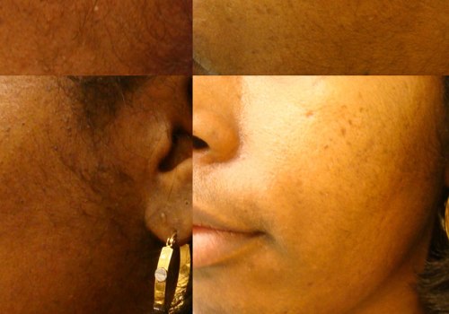 Can Chemical Peel Remove Moles Safely?