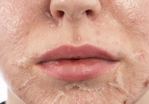 When to Use a Chemical Peel for Optimal Results