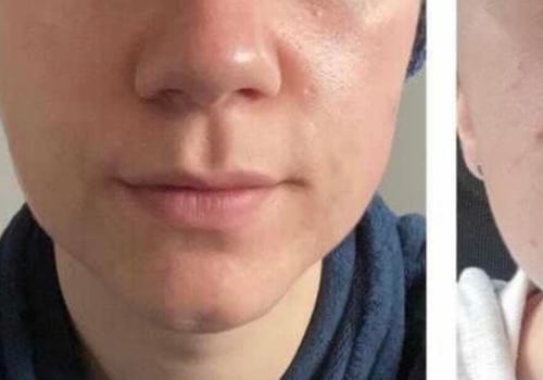 What Chemical Peel is Best for Acne Scars?